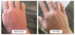 Eczema Before After Result